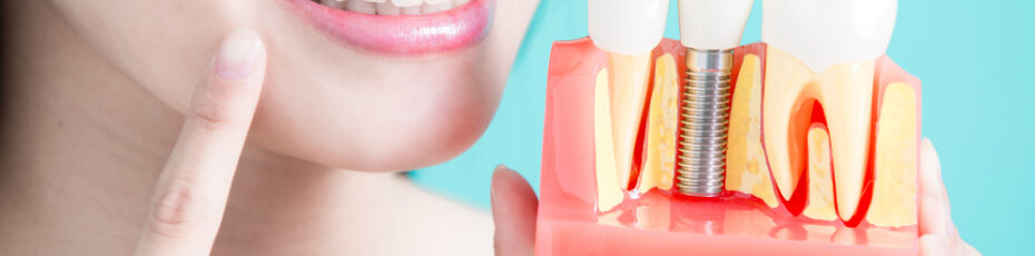 dental implants a step by step guide and expectations