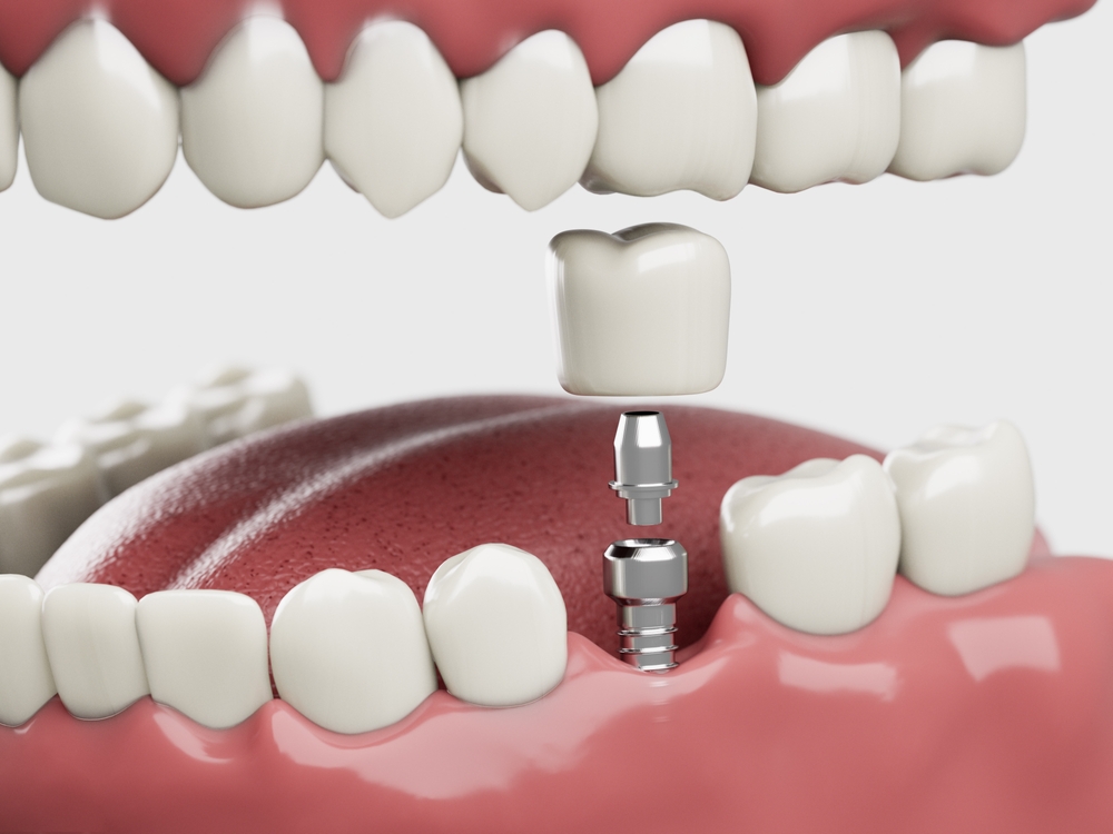 how dental implants improve oral health and restore functionality